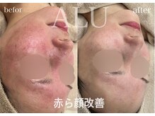 アルフォービューティー 難波店(ALU for beauty)/赤み症例
