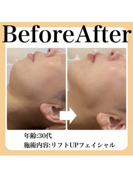 スイ(sui)/Before&After