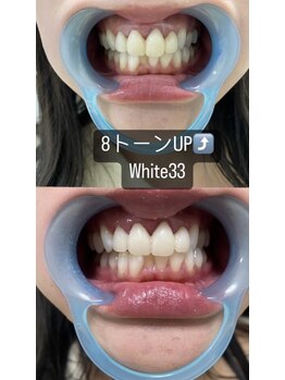 アイブロウ33 久留米店/【ホワイトニングBefore After】