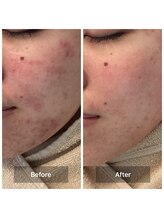 モカ 天王寺店(MOKA)/剥離3回　ホホニキビ　ハーブ