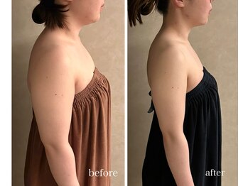 プレジール(Plaisir)/レモンボトル＆高周波＆モナリザ