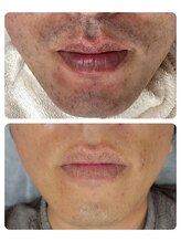 エアリアル 大牟田店/カミソリ負けから解放！