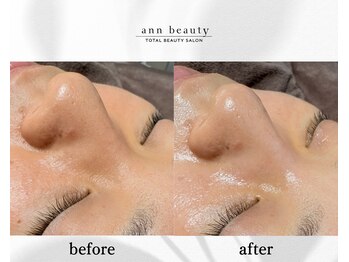 アン ビューティー(ann beauty)/施術1回【症例写真】