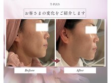 ティープラス 大和鶴間店(T-PLUS)の雰囲気（【エステ】毛穴引き締め&シワたるみ改善最新小顔リフトHIRF.WAVE）