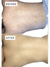 ビジュープラス 筑西下館店(Bijou+)/【30代お悩み】背中／4回施術