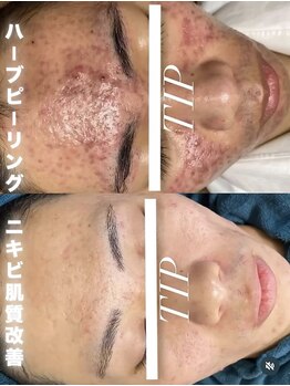 ベル(Belle)の写真/【何を試しても改善されないニキビ肌からの脱却】本気で肌質改善を目指したい方必見！ニキビ肌卒業生多数♪