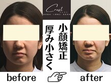 クレスト(CREST)/ビフォーアフター【小顔名古屋】