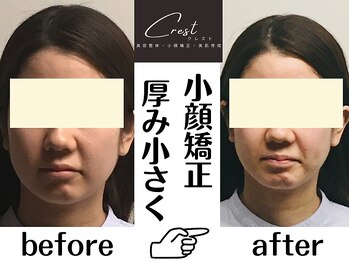 クレスト(CREST)/ビフォーアフター【小顔名古屋】