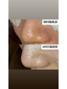 ダリージュ(Daliege)の写真/毛穴でお悩みの方必見!奥の皮脂汚れまで丁寧に取り除く極上のケアを体験★