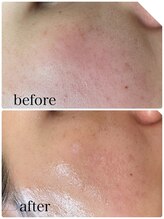 チャーム(Charm)/マイクロニードルピーリング