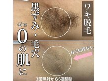 サロン(SALON)/メンズ脱毛：ワキ
