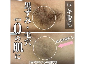 サロン(SALON)/メンズ脱毛：ワキ