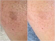 サロン マリー(SALON MARIE)/最新光フェイシャル３回目！