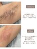 黒いポツポツ解消！ダブル脱毛《脇シュガーリング&光脱毛》+保湿ケア
