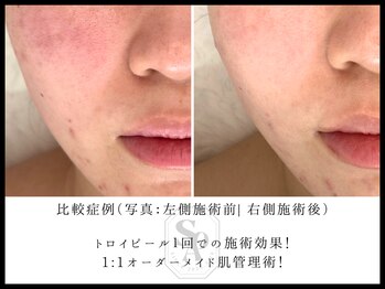 韓国肌管理室 ソア(soa)/【肌改善に終止符を】