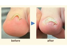 かがわ接骨院 高松伏石院/巻き爪治療お任せください！