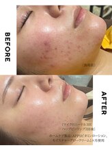 ホソナル(HOSONAL)/肌質改善1ヶ月の経過