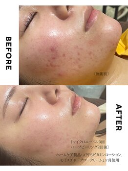 ホソナル(HOSONAL)/肌質改善1ヶ月の経過