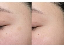 エメ(Aimer)/【20代シミ結果写真☆】