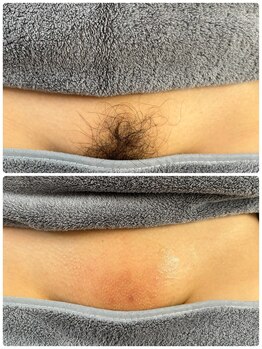 シュガーリングハウス ベル(Bell)/人気No.1　VIOダブル脱毛