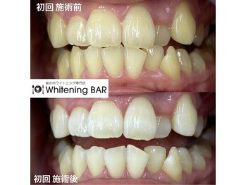 ホワイトニングバー 大宮店/初回の効果に満足のお客様