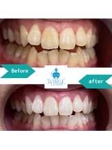 ティンクルホワイト 上尾店/ホワイトニングBefore After