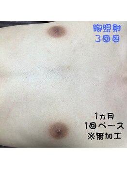 フェリッセ(FELISSE)/胸脱毛 照射3回目【Y様】