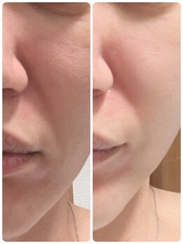 ラグーン(Lagoon)/WINBACK×小顔矯正コルギ