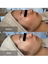 マリモ鍼灸接骨院/お肌のトーンアップはこれ♪