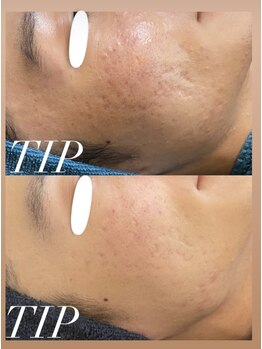 ムーンリズム(Moonlism)/【TIPハーブ症例】