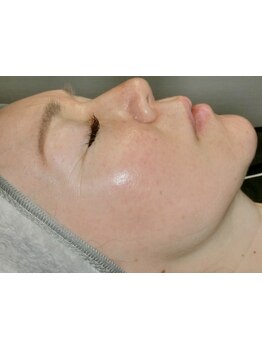 ホウレイ線・たるみ改善！予防ケア