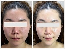 恵比寿脱毛 シーズ(She’s)の雰囲気（透明感◎リフトアップ◎エステ版ソフトダーマで美容液導入）