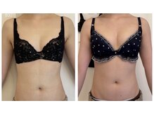 美人バスト 南森町店/バストアップ◇症例◇