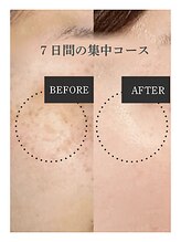 《韓国美容専門店》BELL BEAUTY SALON &nbsp;&nbsp;小顔/毛穴洗浄/シミ/痩身&nbsp;シミケア #施術経過