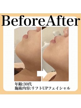 スイ(sui)/Before&After