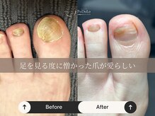ポドロ(PoDoLo)の雰囲気（【肥厚爪】足を見るのが嫌だったのが楽しみ　になりました♪）