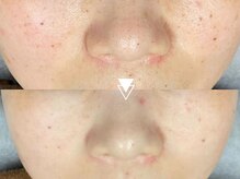 【乾燥する秋冬の救世主】最新機器×医療提携！高密度超音波で深部から潤い満タンの水光肌◎水玉LDM￥7980