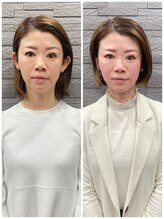 長寿鍼灸院 長寿整骨院/ハリネズミ女優美容鍼効果★