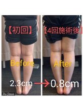 クシロ鍼灸整骨院/【O脚矯正】施術例