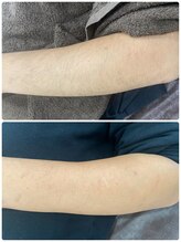 ボニート 堺東店(BONITO)/メンズ腕脱毛７回目