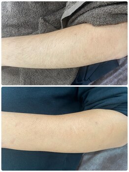 ボニート 堺東店(BONITO)/メンズ腕脱毛７回目