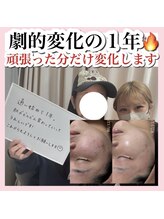 アルムダアクア 天王寺店(Aleumda AQUA)/ハーブピーリング/大阪/天王寺