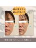 【気になる頬骨のでっぱりに】小顔調整+頬骨調整　60分　8400円