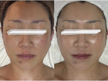 フォー(For...)/シミケア◇クリスティーナ