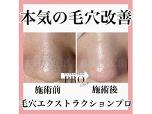 シャンス(CHANCE)の雰囲気（リピート率97%！本気の毛穴技術【毛穴エクストラクションプロ】）