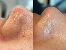 エミナル(Eminal)/◆毛穴フルコース　1回