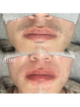 サロンロン 横浜関内(SALON RON)/60分コース/美容電気脱毛