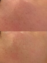 クラルテアンドコー(Salon Clarte&Co.)/韓国エステ版ポテンツァ♯1回