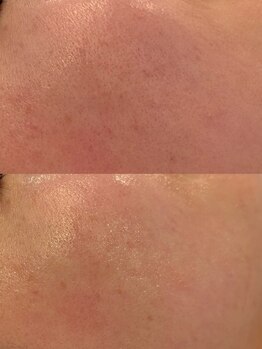 クラルテアンドコー(Salon Clarte&Co.)/韓国エステ版ポテンツァ♯1回