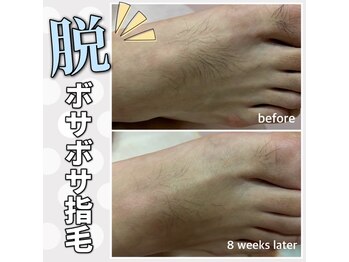 サロン(SALON)/メンズ脱毛：脚